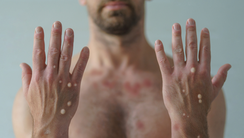 RN registra os primeiros casos de mpox em 2026