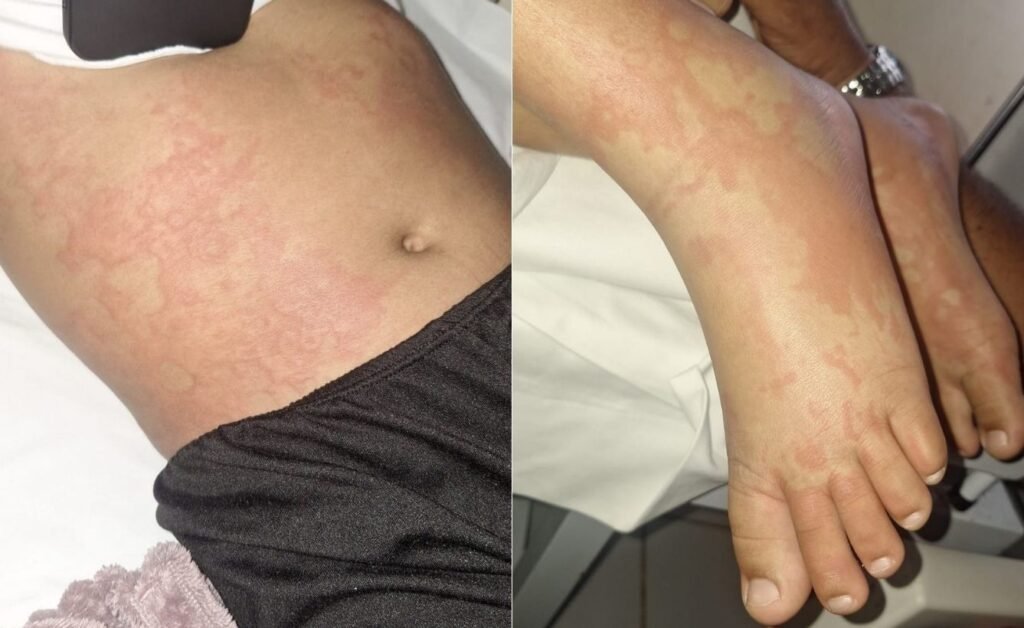 Criança internada em Natal é investigada por possível contaminação de detergente