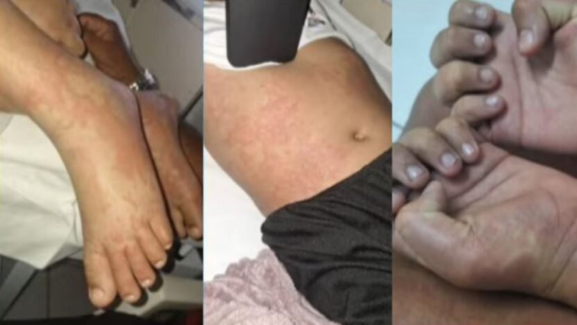 Infectologista descarta bactéria de detergente como causa do caso em Natal